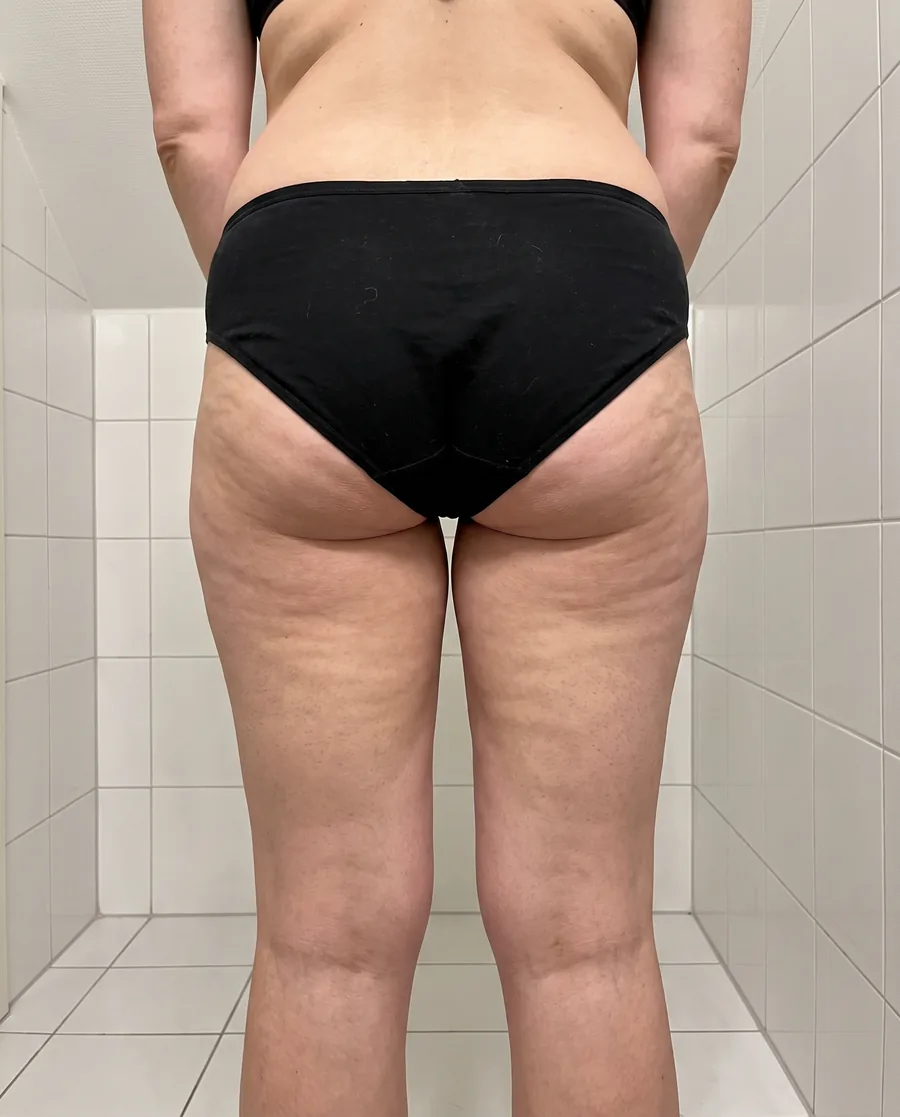 Bumbum e coxas com celulite aparente
